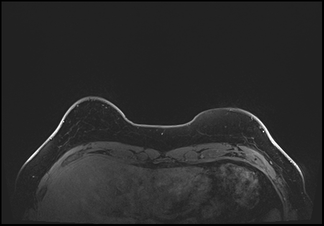 Normal breast MRI - dense breasts (Radiopaedia 80454-93850 C 21).jpg