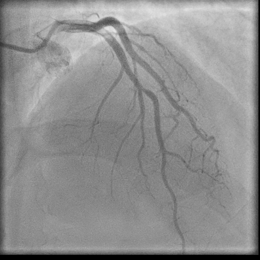 Normal coronary angiogram (DSA) (Radiopaedia 63081-71571 E 52).jpg