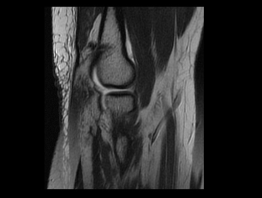 File:Normal elbow arthrograms (Radiopaedia 75550-86805 Sagittal PD 18).jpg