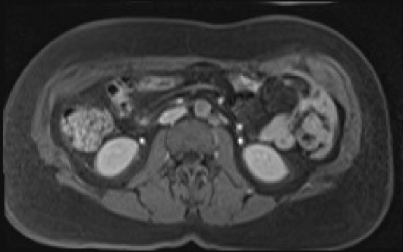 File:Normal hepatobiliary phase liver MRI (Radiopaedia 58968-66230 A 75).jpg