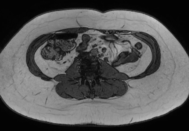 File:Normal liver MRI with Gadolinium (Radiopaedia 58913-66163 B 3).jpg