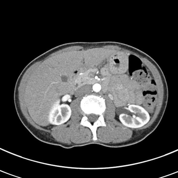 File:Normal multiphase CT liver (Radiopaedia 38026-39996 B 34).jpg