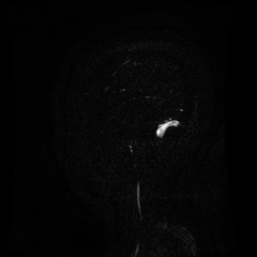 Normal noncontrast MR venography (Radiopaedia 87578-103957 A 154).jpg