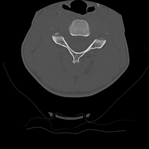 Normal trauma spine imaging (age 16) (Radiopaedia 45335-49358 Axial bone window 32).jpg