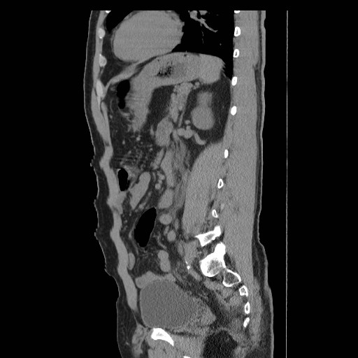 File:Obstructed kidney with perinephric urinoma (Radiopaedia 26889-27066 B 44).jpg