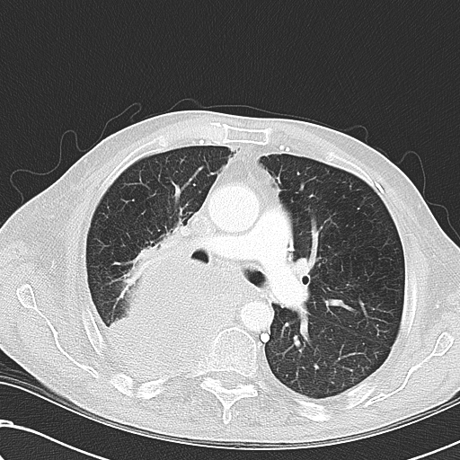 File:Obstructive superior vena cava tumor thrombus (Radiopaedia 28046-28306 Axial lung window 23).jpg
