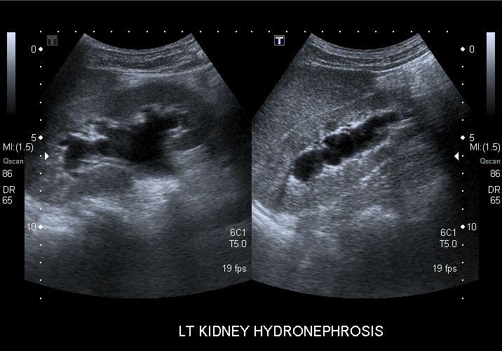 File:Obstructive uropathy and urolithiasis on ultrasound (Radiopaedia 25562-25758 B 1).jpg