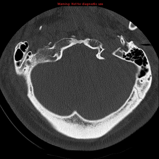 File:Occipital condyle fracture (Radiopaedia 18366-18208 Axial bone window 8).jpg
