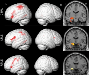 Memory encoding activations in controls, left temporal lobe epilepsy individuals, and right temporal lobe epilepsy individuals