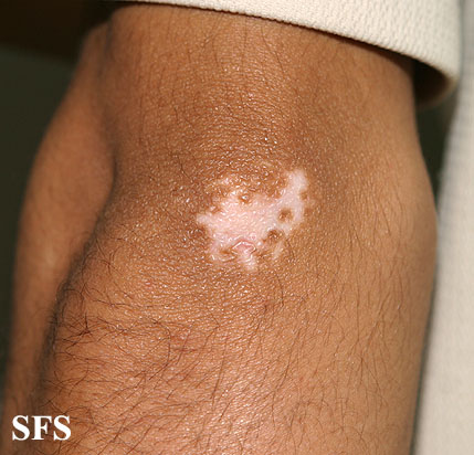 File:Vitiligo (Dermatology Atlas 37).jpg