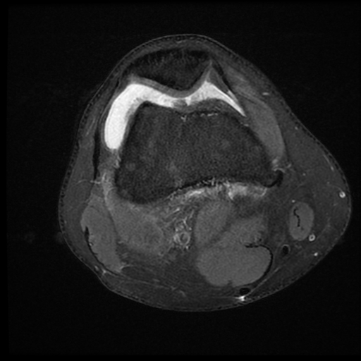 File:ACL acute full thickness tear - deep lateral femoral sulcus sign (Radiopaedia 38594-40740 Axial PD fat sat 8).jpg