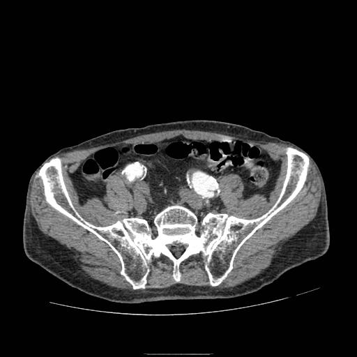 Abdominal aortic aneurysm (Radiopaedia 13341-13340 Axial C+ arterial phase 181).jpg