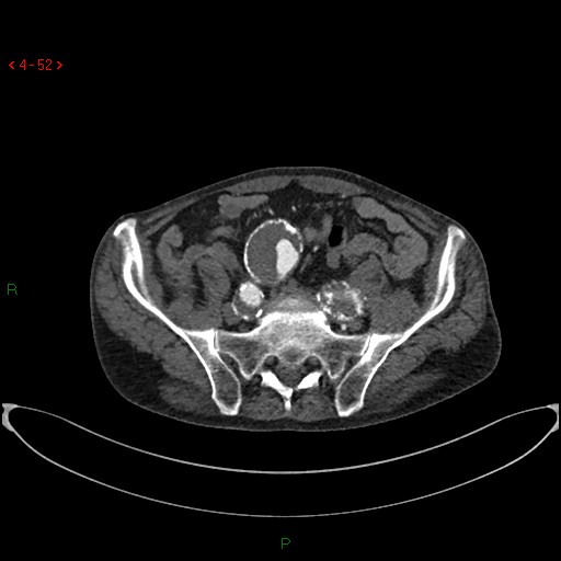File:Abdominal aortic aneurysm (Radiopaedia 16155-15834 Axial C+ arterial phase 32).jpg