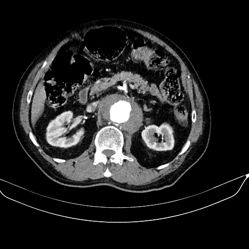 Abdominal aortic aneurysm (Radiopaedia 67117-76452 Axial C+ arterial phase 51).jpg