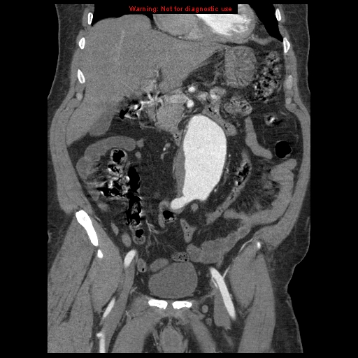 Abdominal aortic aneurysm (Radiopaedia 8190-9038 Coronal C+ arterial phase 48).jpg