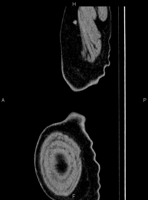 Abdominal aortic aneurysm (Radiopaedia 83094-97462 Sagittal renal cortical phase 126).jpg