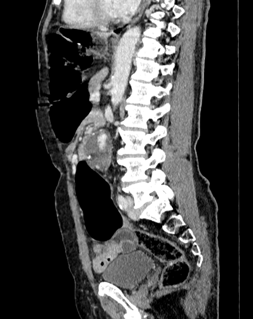 Abdominal aortic aneurysm (Radiopaedia 83581-98689 Sagittal C+ portal venous phase 64).jpg