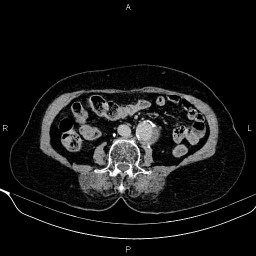 Abdominal aortic aneurysm (Radiopaedia 85063-100606 Axial C+ delayed 65).jpg