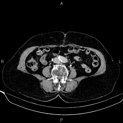Abdominal aortic aneurysm (Radiopaedia 85063-100606 Axial C+ delayed 78).jpg