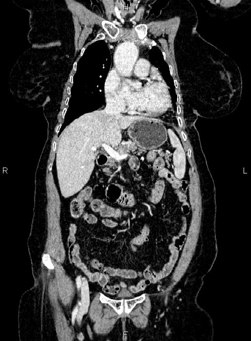 Abdominal aortic aneurysm (Radiopaedia 85063-100606 Coronal C+ arterial phase 17).jpg