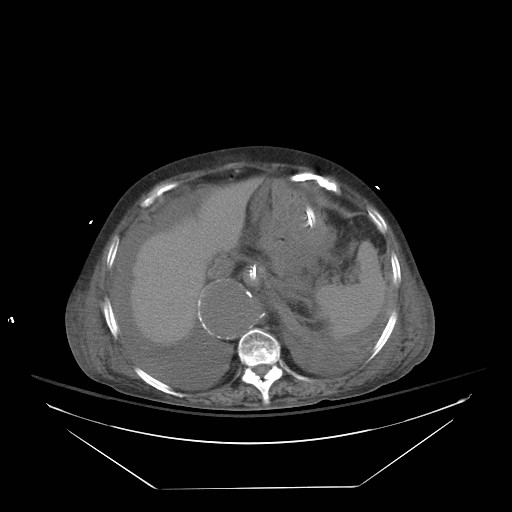 Abdominal aortic aneurysm - impending rupture (Radiopaedia 19233-19247 Axial non-contrast 37).jpg