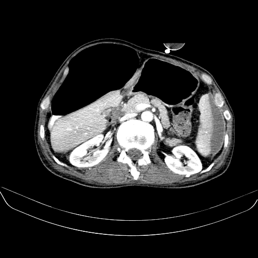 File:Abdominal collection due to previous cecal perforation (Radiopaedia 80831-94320 Axial C+ portal venous phase 73).jpg