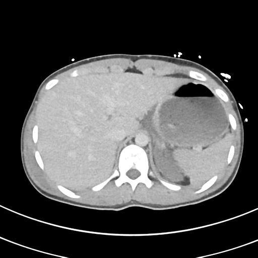 File:Abdominal multi-trauma - devascularised kidney and liver, spleen and pancreatic lacerations (Radiopaedia 34984-36486 Axial C+ delayed 14).png