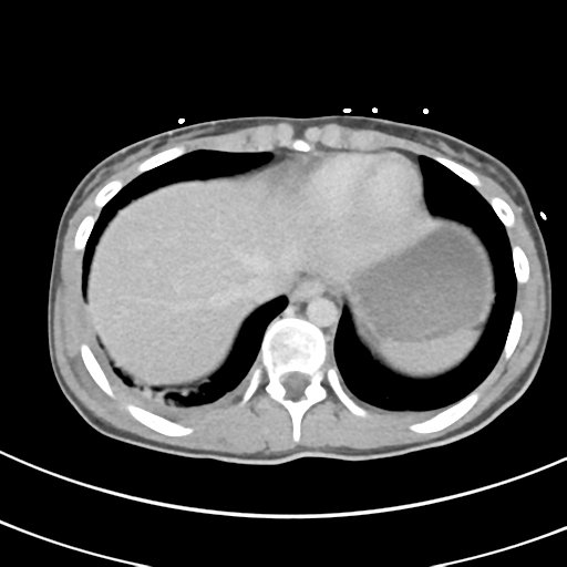 File:Abdominal multi-trauma - devascularised kidney and liver, spleen and pancreatic lacerations (Radiopaedia 34984-36486 Axial C+ delayed 6).png