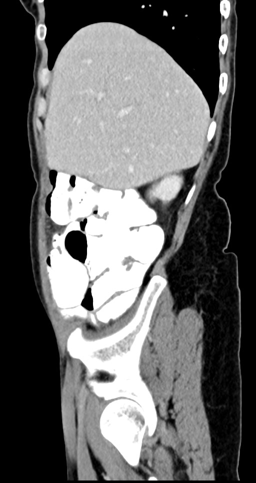 Abdominal wall and retroperitoneal tuberculosis (Radiopaedia 88137-104729 Sagittal C+ portal venous phase 119).jpg