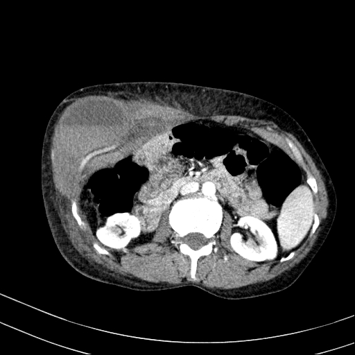 Abdominal wall hematoma with active bleeding (Radiopaedia 83915-99117 Axial renal cortical phase 30).jpg