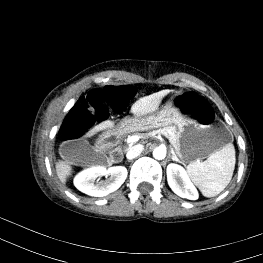 Abdominal wall hematoma with active bleeding (Radiopaedia 83915-99117 Axial renal cortical phase 7).jpg