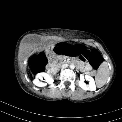 Abdominal wall hematoma with active bleeding (Radiopaedia 83915-99122 Axial contrast-enhanced CT 1).jpg