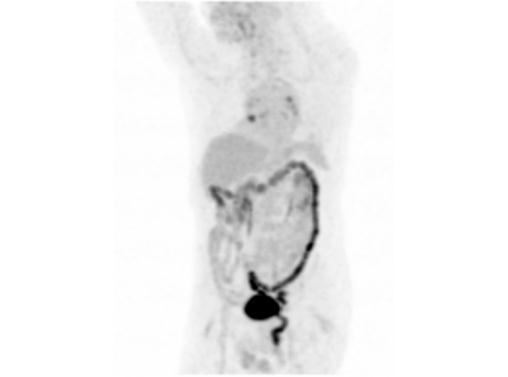 File:Abdominal wall metastasis from colorectal carcinoma (Radiopaedia 31016-31719 Rotational MIP 4).jpg