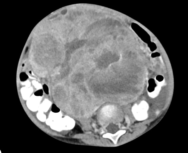 Abdominopelvic rhabdomyosarcoma (Radiopaedia 78356-90984 Axial C+ portal venous phase 105).jpg