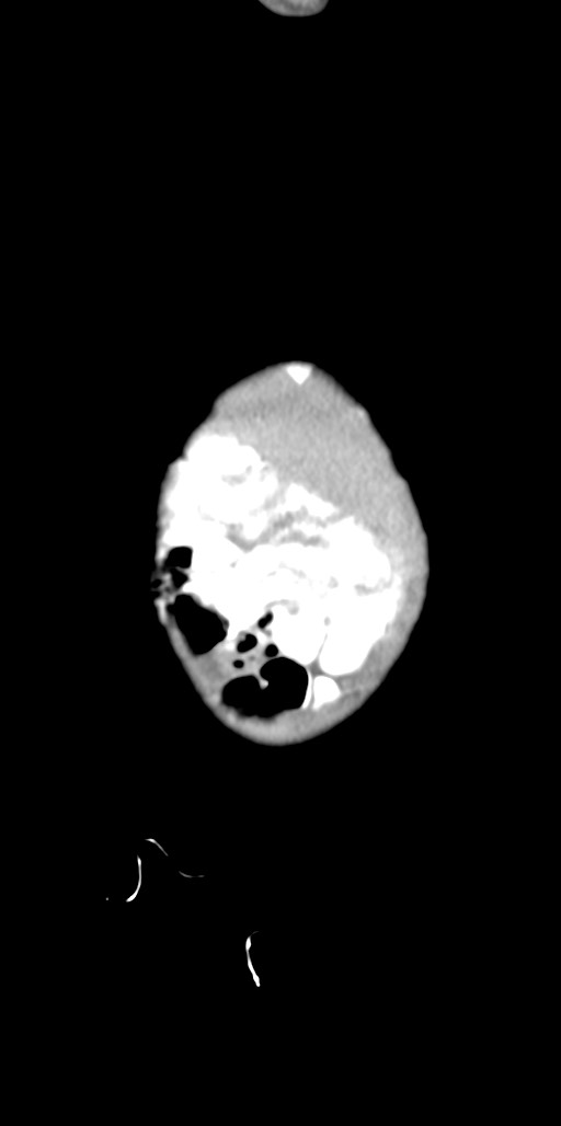 Abdominopelvic rhabdomyosarcoma (Radiopaedia 78356-90984 Sagittal C+ portal venous phase 96).jpg