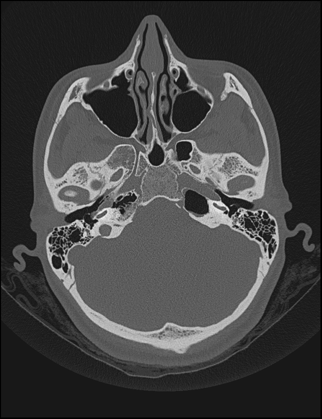 Aberrant right internal carotid artery (Radiopaedia 65191-74198 Axial non-contrast 39).jpg