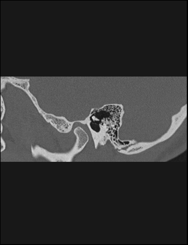 Aberrant right internal carotid artery (Radiopaedia 65191-74198 Sagittal non-contrast 40).jpg