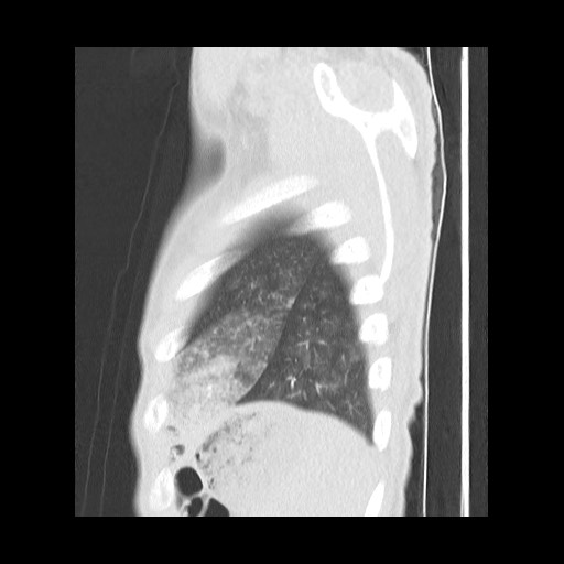 File:Accessory left horizontal fissure with lingular pneumonia (Radiopaedia 53763-59843 Sagittal lung window 60).jpg