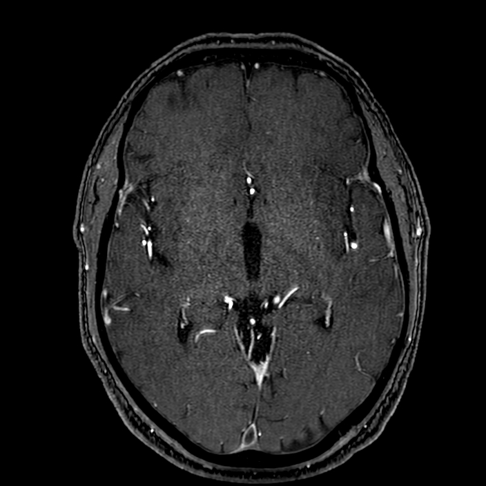 Accessory middle cerebral artery (Radiopaedia 73114-83828 Axial MRA 95).jpg