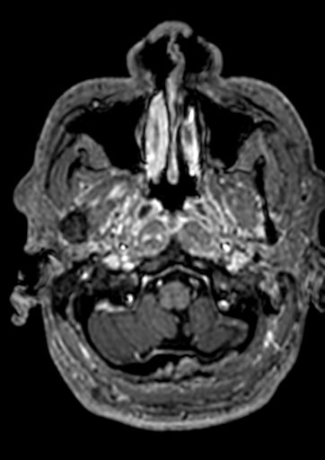 Accessory middle cerebral artery (Radiopaedia 73114-83828 Axial T1 C+ 176).jpg