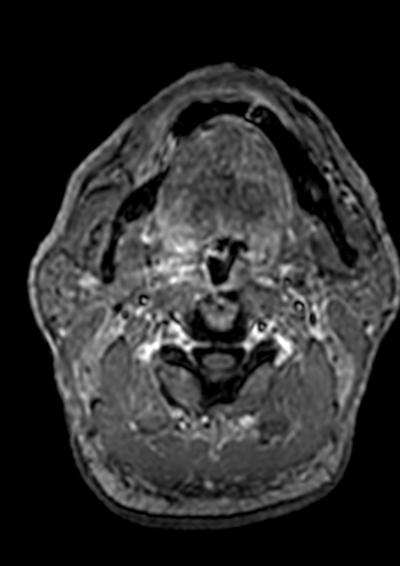 Accessory middle cerebral artery (Radiopaedia 73114-83828 Axial T1 C+ 278).jpg