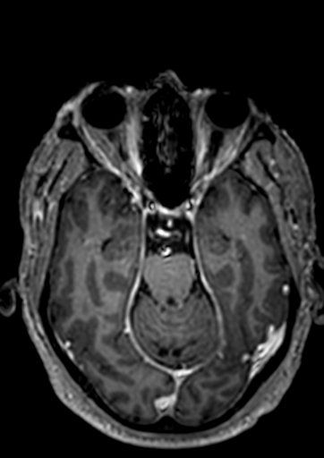 Accessory middle cerebral artery (Radiopaedia 73114-83828 Axial T1 C+ 90).jpg
