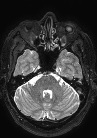 Accessory middle cerebral artery (Radiopaedia 73114-83828 Axial T2 157).jpg
