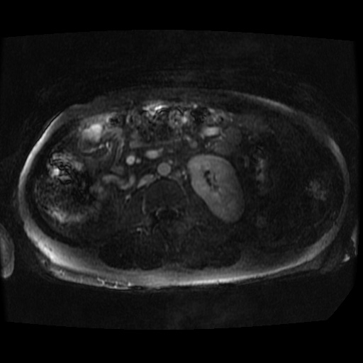 File:Acinar cell carcinoma of the pancreas (Radiopaedia 75442-86668 Axial T1 C+ fat sat 10).jpg