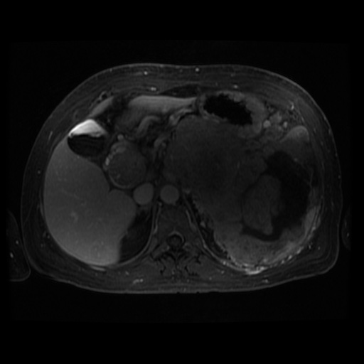 Acinar cell carcinoma of the pancreas (Radiopaedia 75442-86668 D 78).jpg