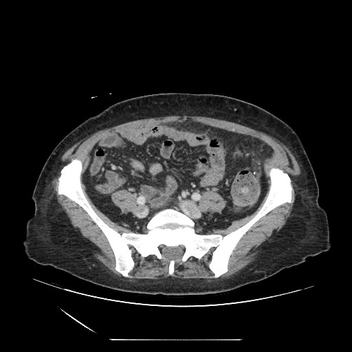 Acinar cell carcinoma of the pancreas (Radiopaedia 75442-86669 Axial C+ portal venous phase 104).jpg