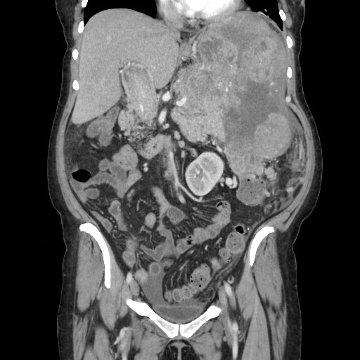 Acinar cell carcinoma of the pancreas (Radiopaedia 75442-86669 Coronal C+ portal venous phase 56).jpg