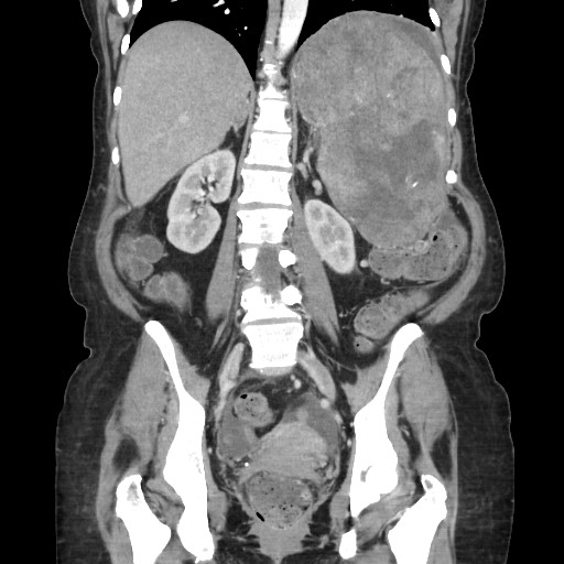 Acinar cell carcinoma of the pancreas (Radiopaedia 75442-86669 Coronal C+ portal venous phase 82).jpg