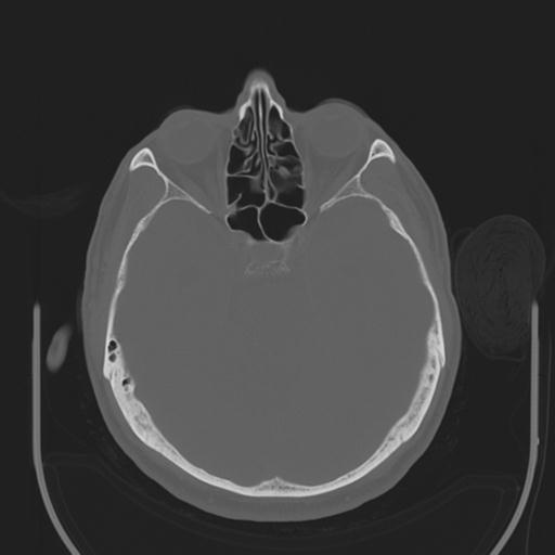 File:Acoustic schwannoma (Radiopaedia 29488-29982 AXIAL BONE THICK non-contrast 17).jpg