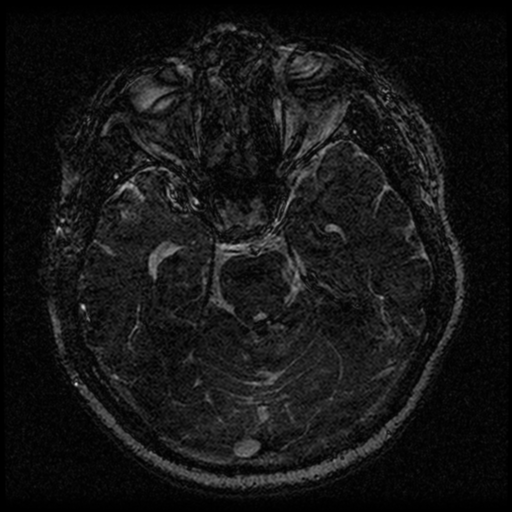 Acoustic schwannoma (Radiopaedia 33045-34060 Axial T2 68).png